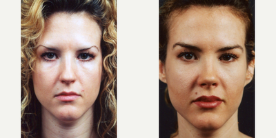 Lip Fillers before and after photo
