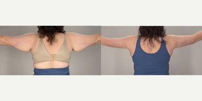 Arm Lift before and after photo