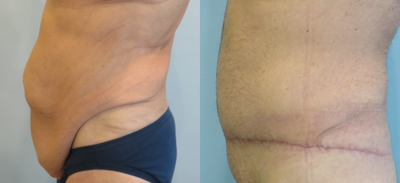 Body Lift before and after photo