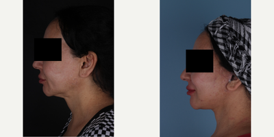 Facelift before and after photo