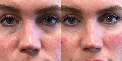 Juvederm before and after photo