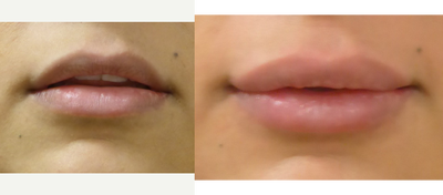 Lip Fillers before and after photo
