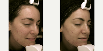 Microneedling before and after photo