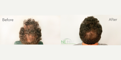 PRP Injections before and after photo