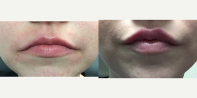 Restylane before and after photo
