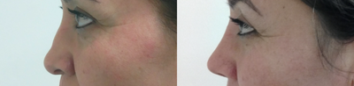 Revision Rhinoplasty before and after photo