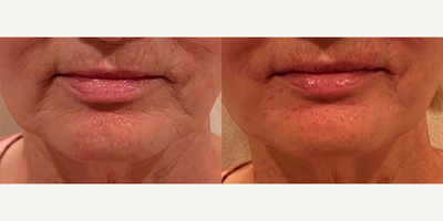 Botox before and after photo