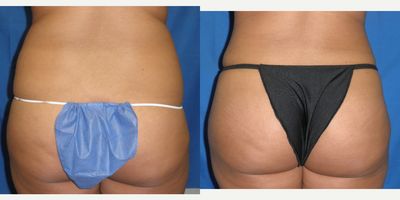 Brazilian Butt Lift before and after photo