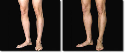Calf Implant before and after photo