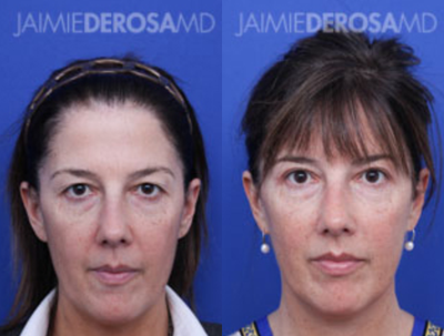 Eyelid Surgery before and after photo