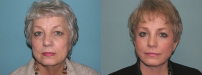 Facelift before and after photo