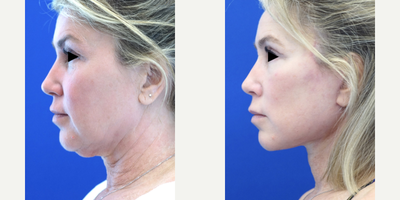Facelift before and after photo