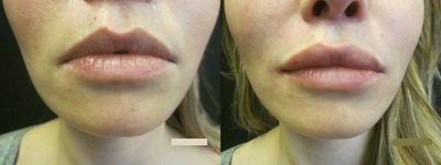 Lip Fillers before and after photo
