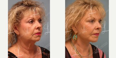 Lower Facelift before and after photo