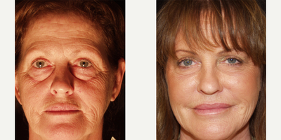 Nonsurgical Facelift before and after photo