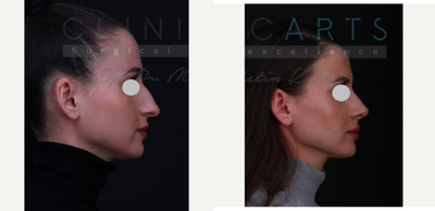 Rhinoplasty before and after photo