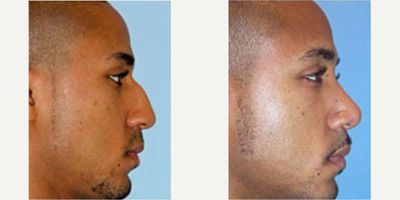 Rhinoplasty before and after photo