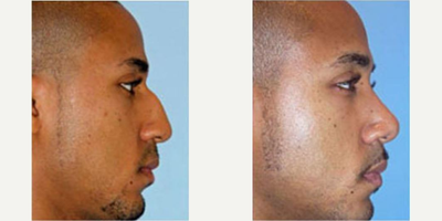 Rhinoplasty before and after photo