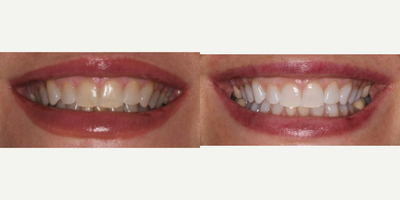 Teeth Whitening before and after photo