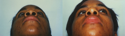African American Rhinoplasty before and after photo