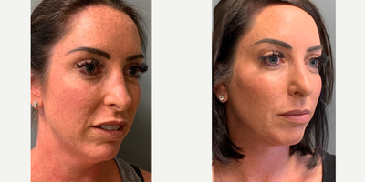 Deep Plane Facelift before and after photo