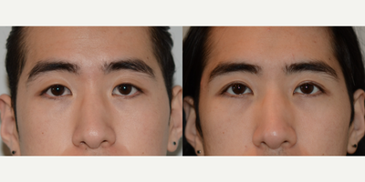 Double Eyelid Surgery before and after photo