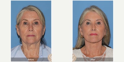 Eyelid Surgery before and after photo