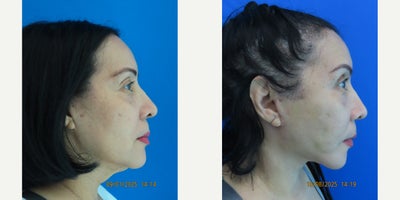 Facelift before and after photo