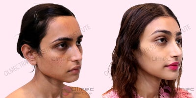 Facial Feminization Surgery before and after photo