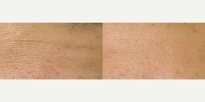 HydraFacial before and after photo