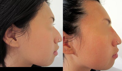 Restylane before and after photo