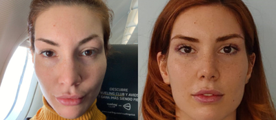 Rhinoplasty before and after photo