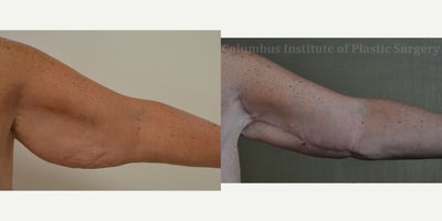 Arm Lift before and after photo