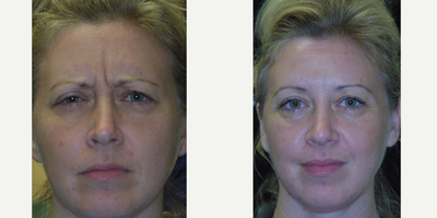 Botox before and after photo