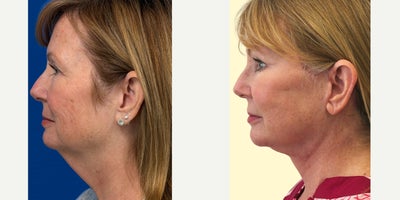 Eyelid Surgery before and after photo