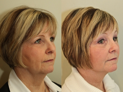 Facelift before and after photo
