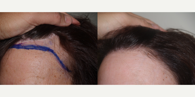 Hair Transplant before and after photo