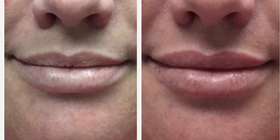 Lip Fillers before and after photo