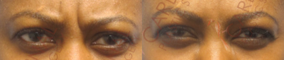 Botox before and after photo