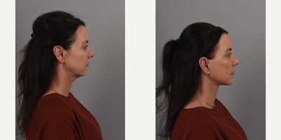 Brow Lift before and after photo