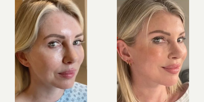 Canthoplasty before and after photo