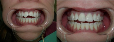 Dental Crown before and after photo