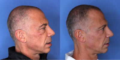 Eyelid Surgery before and after photo