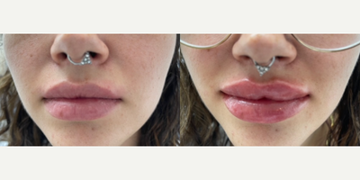 Lip Fillers before and after photo