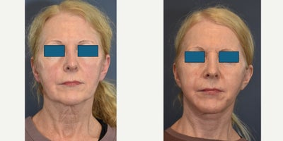 Neck Lift before and after photo