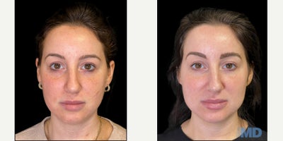 Skin Rejuvenation before and after photo