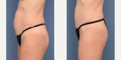 Tummy Tuck before and after photo
