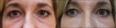Belotero before and after photo