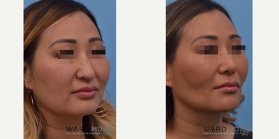 Buccal Fat Removal before and after photo