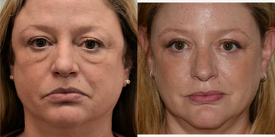 Double Eyelid Surgery before and after photo